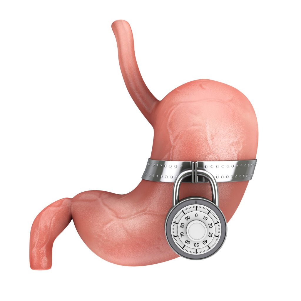 تكميم المعدة - Gastric sleeve